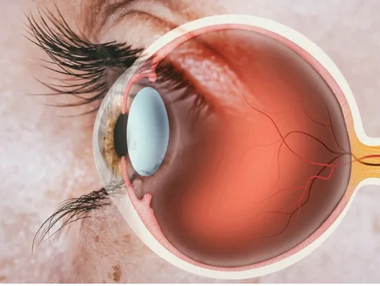 glaucoma-treatment-near-gachibowli