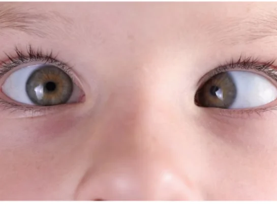 Strabismus-treatment-near-gachibowli